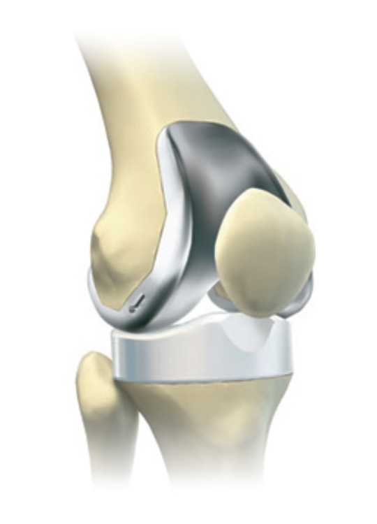 Total Knee Replacement