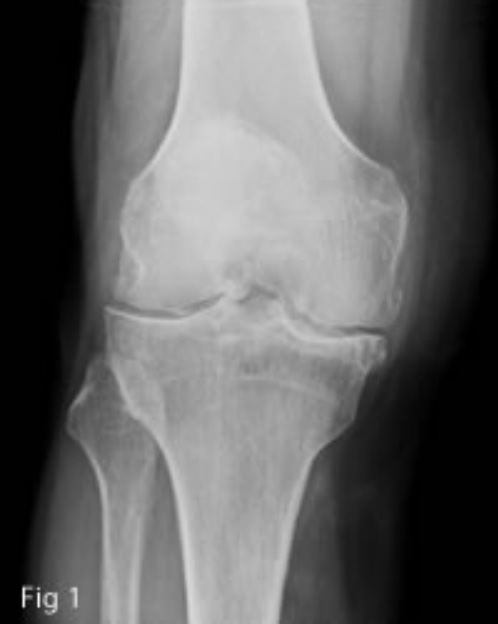 Osteoarthritis of the knee