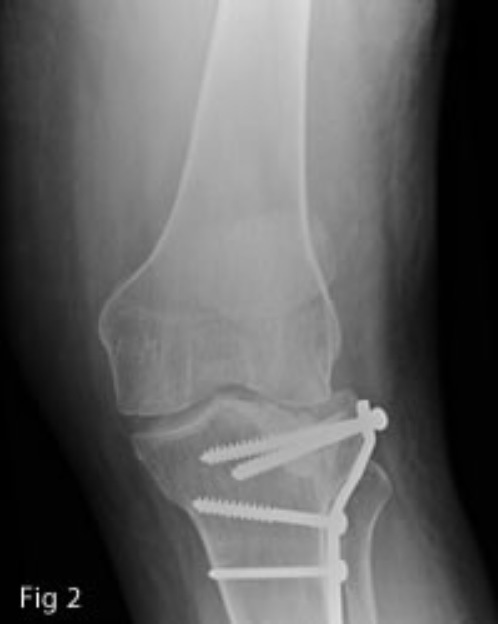 Osteoarthritis following a fracture