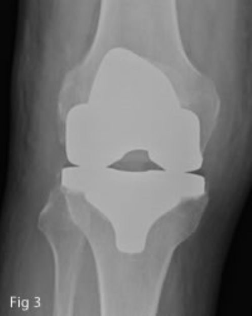 Total knee replacement